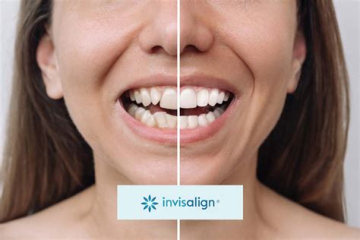 2023 Update: Are B Simone And Invisalign Still An Item?