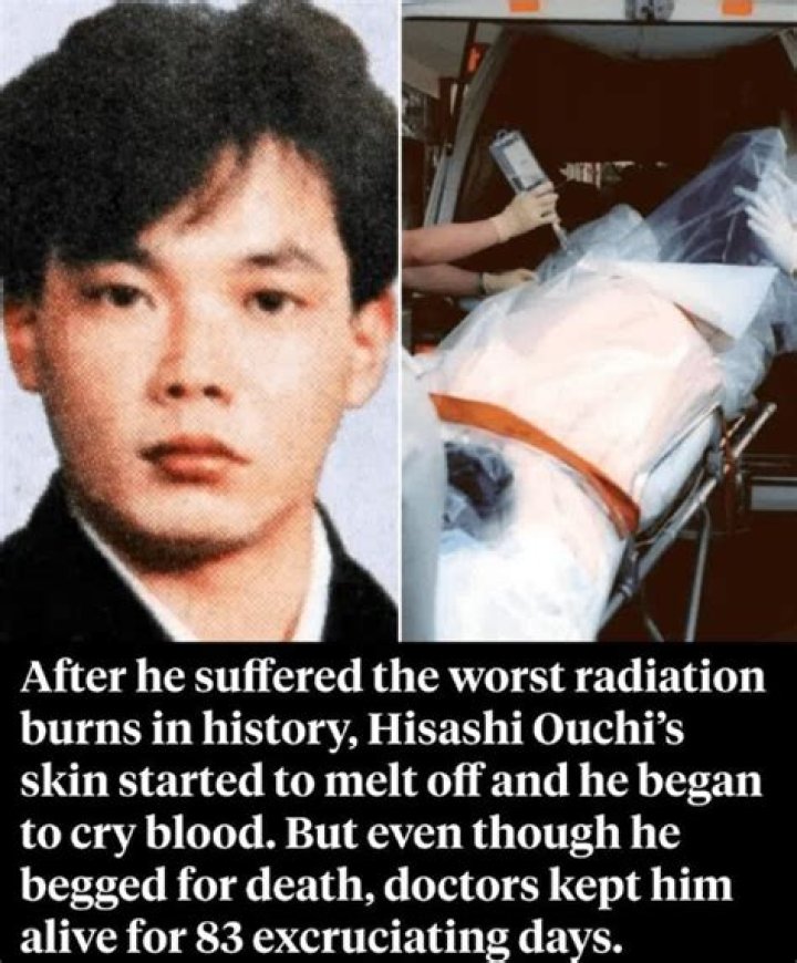 Shocking Photos Of Hisashi Ouchi's Radiation Burns